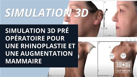 Augmentation Mammaire 3d   Simulation 3d Du0027une Augmentation Mammaire Par Prothèse - Augmentation Mammaire 3d