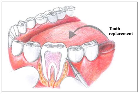 autotransplantation of teeth