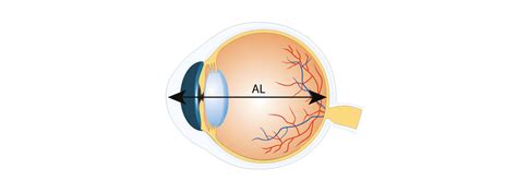Axial Length Of Eye