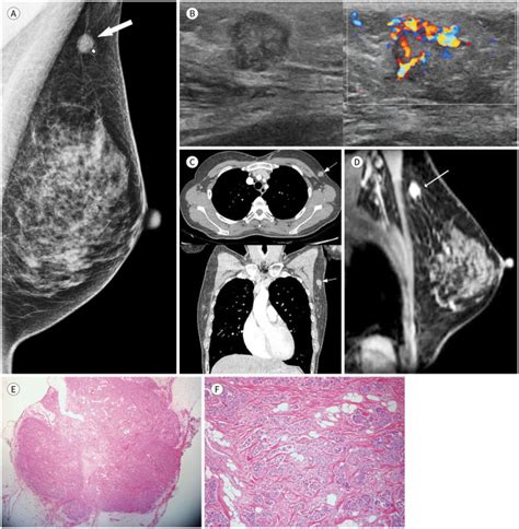 Axillary Tail Of Spence