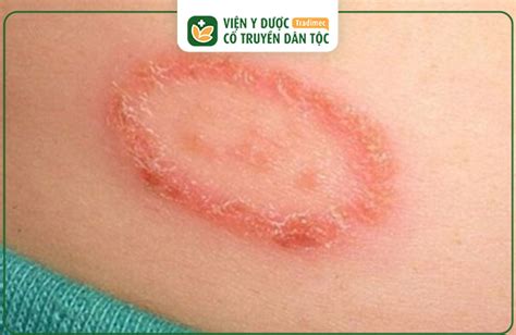 bị lác | BNH LC NG TIN TRIU CHNG NGUYN