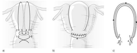 B Lynch Suture