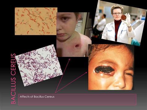 Bacillus Cereus Que Causa
