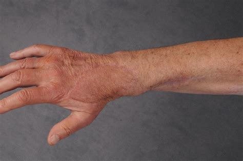 bacteriële artritis