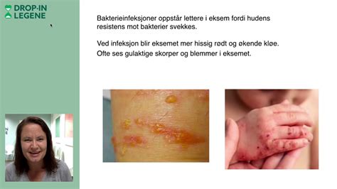 bakterie som ger utslag