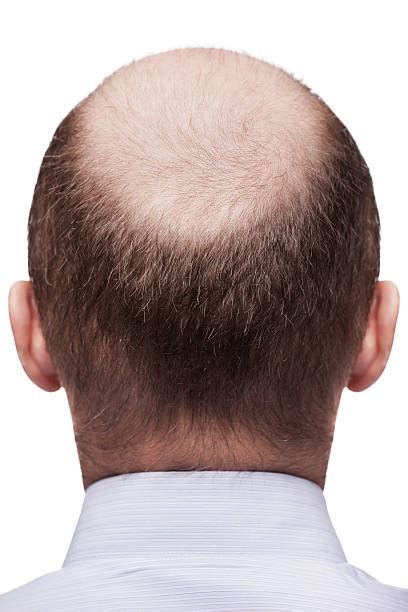bald 대머리