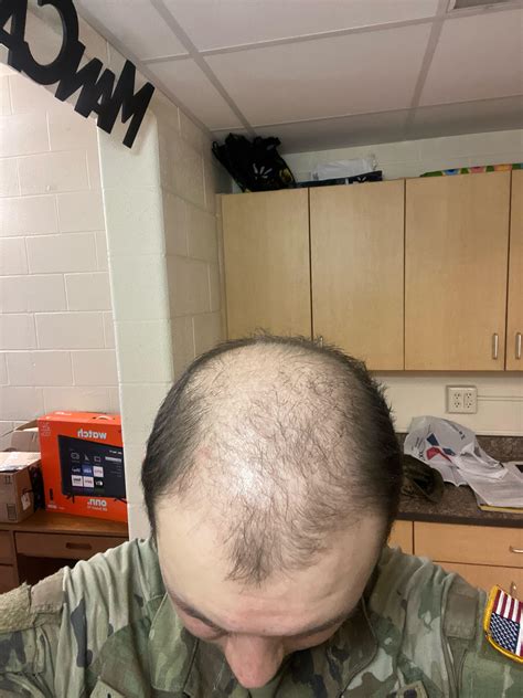 bald in college reddit