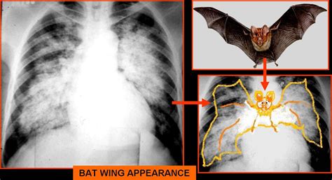 bat wing pattern on chest x ray