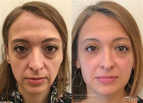 Read Online Before After 