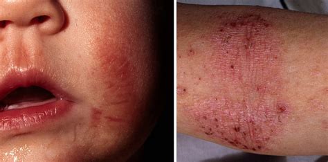 behandling atopisk dermatit