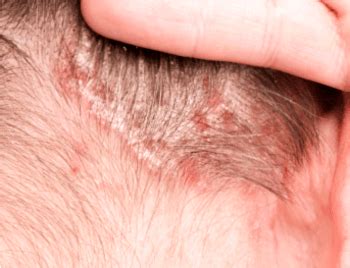 behandling av mjälleksem