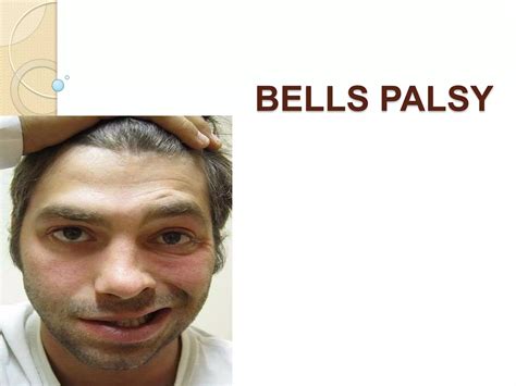 Bells Palsy Ppt