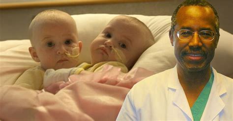 Ben Carson Twins Surgery