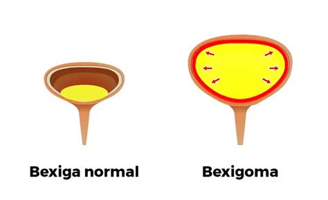 Bexigoma O Que é