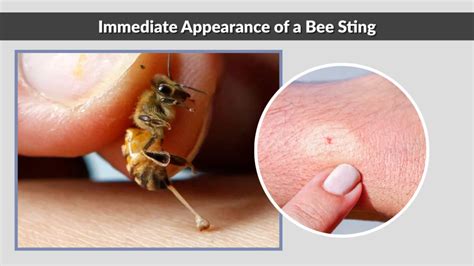 Big Bee Sting Anime