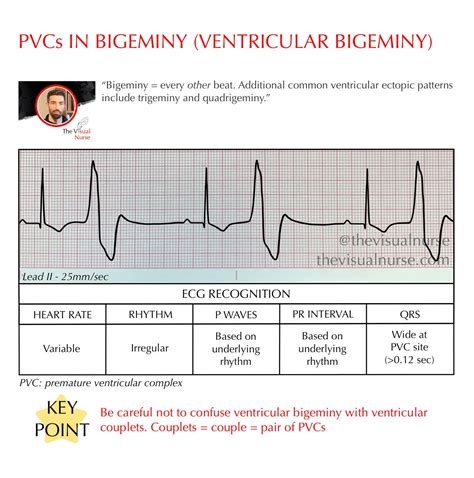 Bigeminy On Ecg