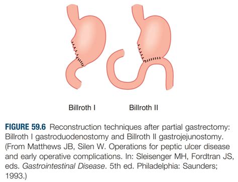 Billroth 1 2