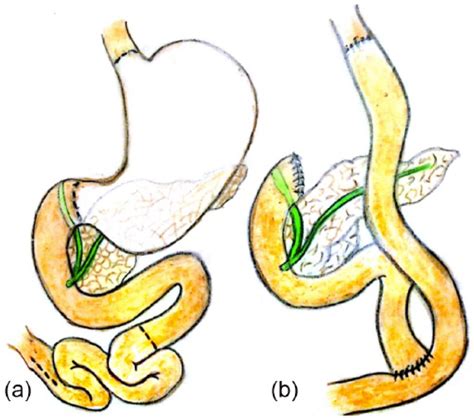 Billroth 2 Operation