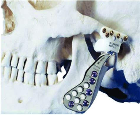 Biomet Microfixation Catalog