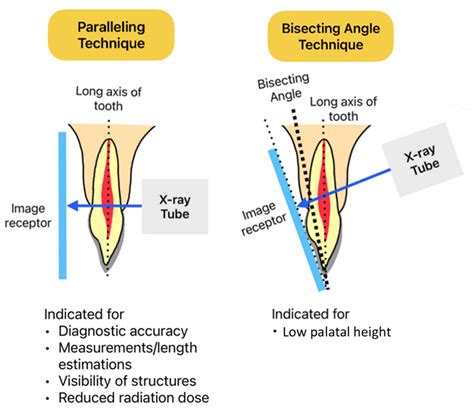 Bisecting Angle Technique