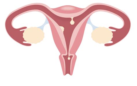 blödningar underlivet polyper