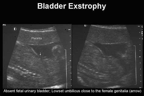 Bladder Exstrophy Findings