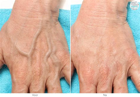 blauwe aders zichtbaar handen