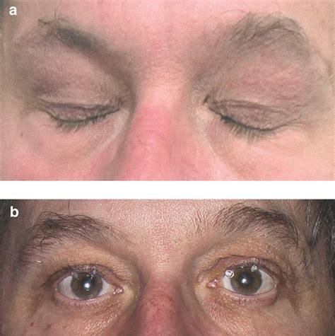 blefarospasme | Blefarospasme Kondisi di Balik Mata Kedutan Alodokter