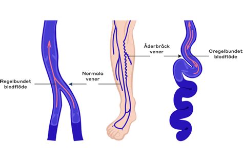 blodcirkulation gips