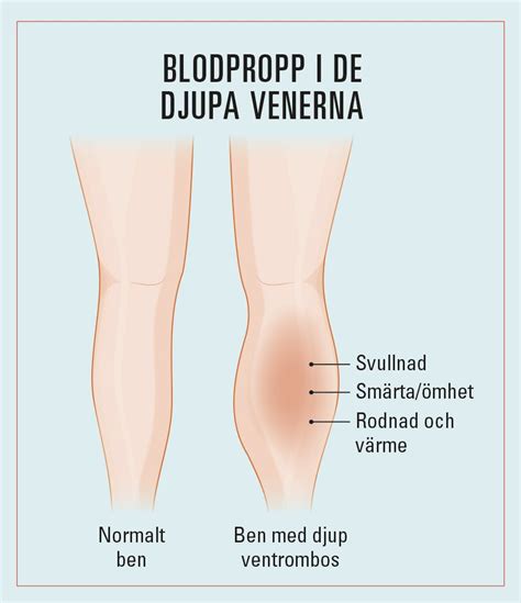 blodpropp benet