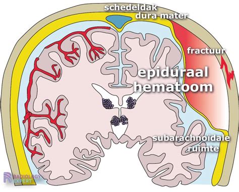 bloeding in hersenen