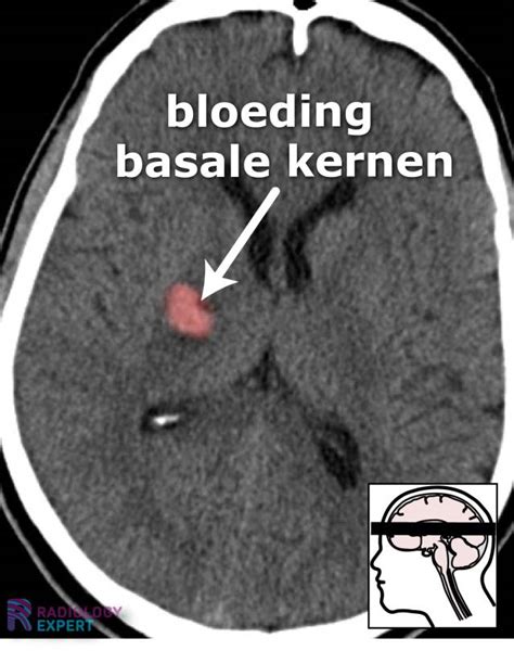 bloeding in parenchym