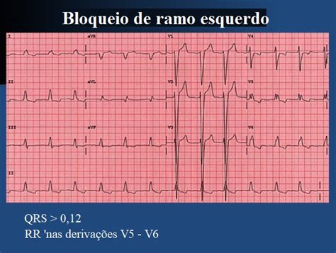 Bloqueio De Ramo Esquerdo