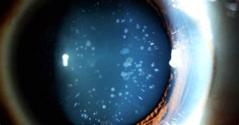Blue Dot Cataract