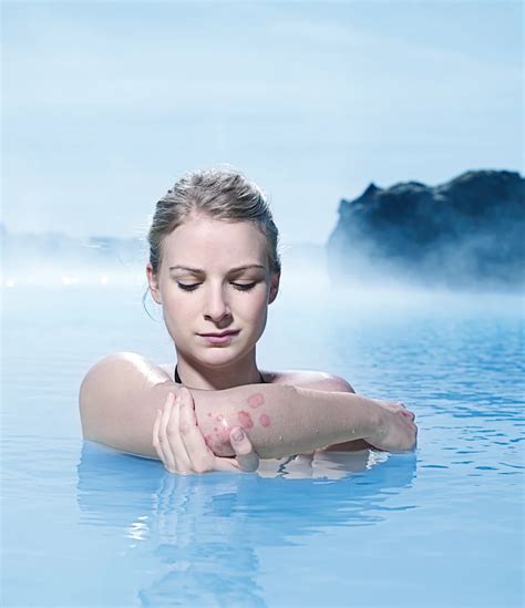 Blue Lagoon Psoriasis