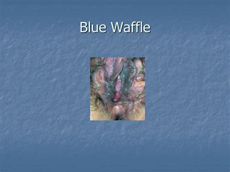 blue wafflé disease