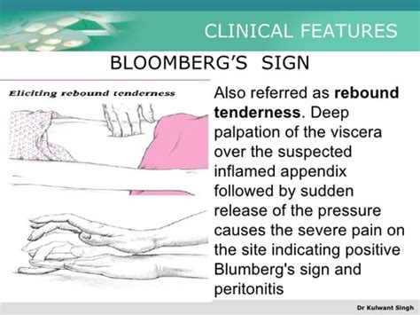 Blumberg Sign