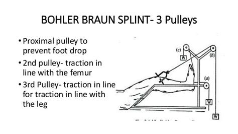 Bohler Braun Splint