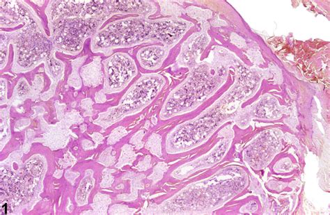 Bone Fibrous Osteodystrophy