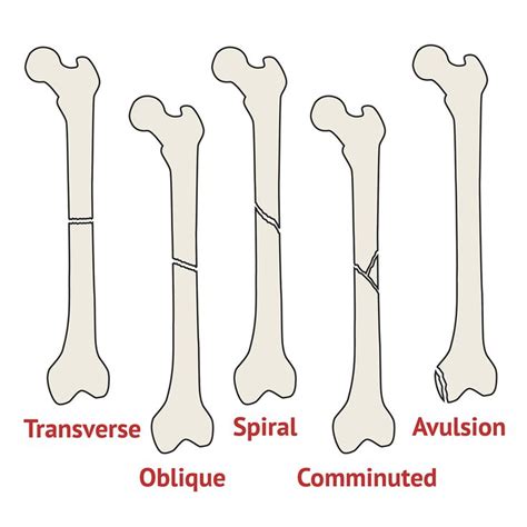 Bone Fractures Worksheet Answers   Types Of Bone Breaks Abpdf Com - Bone Fractures Worksheet Answers