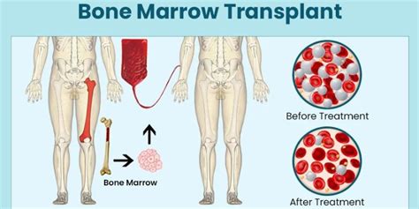 bone marrow transplantation an issue of hematology
