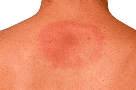 borrelia symtom bilder