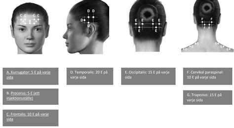 botox migrän  vid  anvisning pris