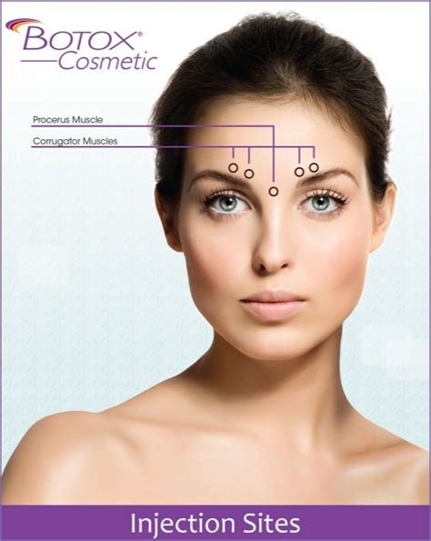 botox points for eyebrow lift Google Search in 2020 Botox injection