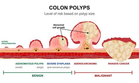 Bowel Polyps Images
