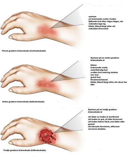 brännskada varar