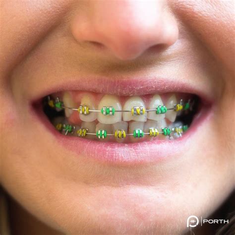 braces color