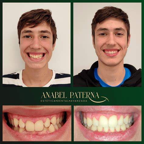 Brackets Antes Y Despues