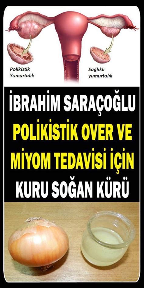 brahim Saraçoğlu'ndan Polikistik Over Sendromu İçin Soğan Kürü Tarifi · polikistik over bitkisel tedavisi İbrahim Saraçoğlu.