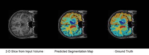 Brain Mri Image Segmentation Matlab Source Code
